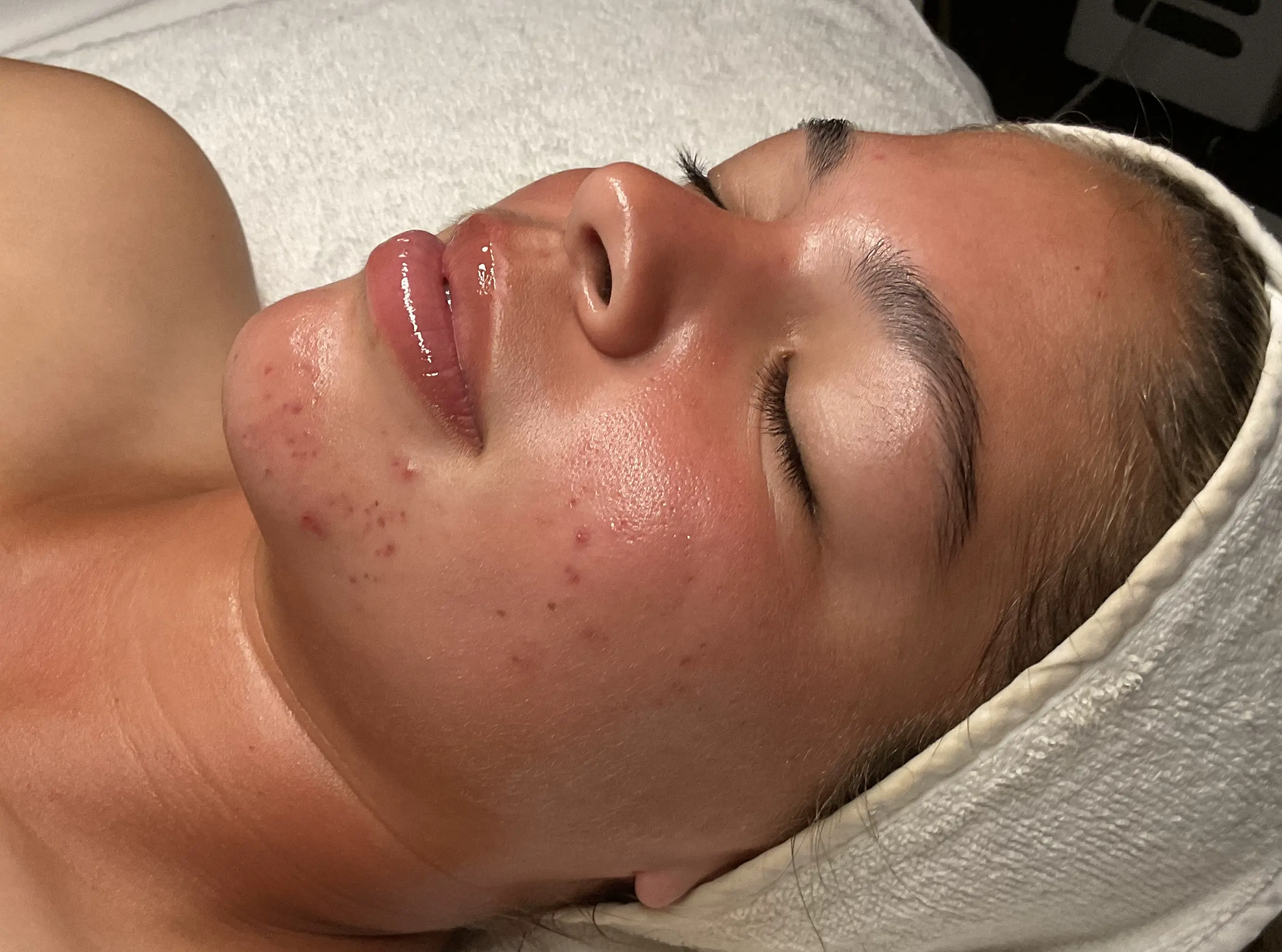 Active acne before treatment at Banyan and Bamboo Austin TX