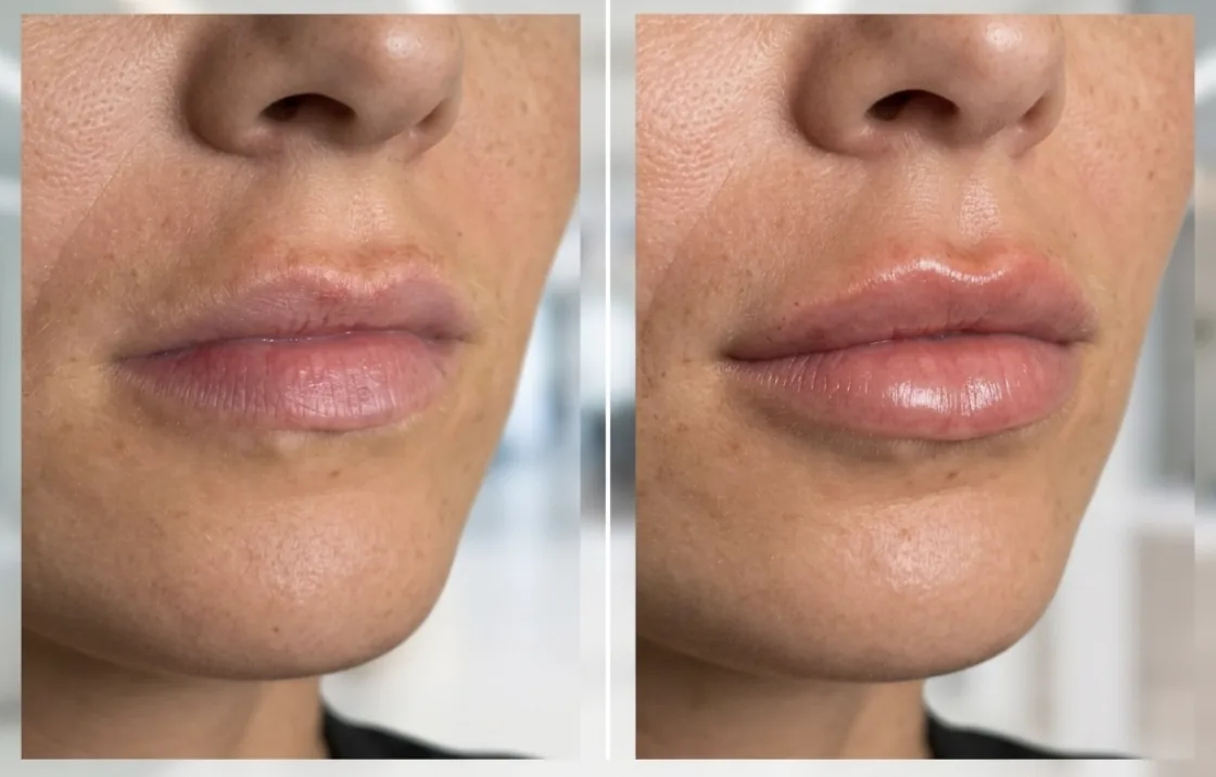 Natural lip enhancement before and after at Banyan & Bamboo in Austin