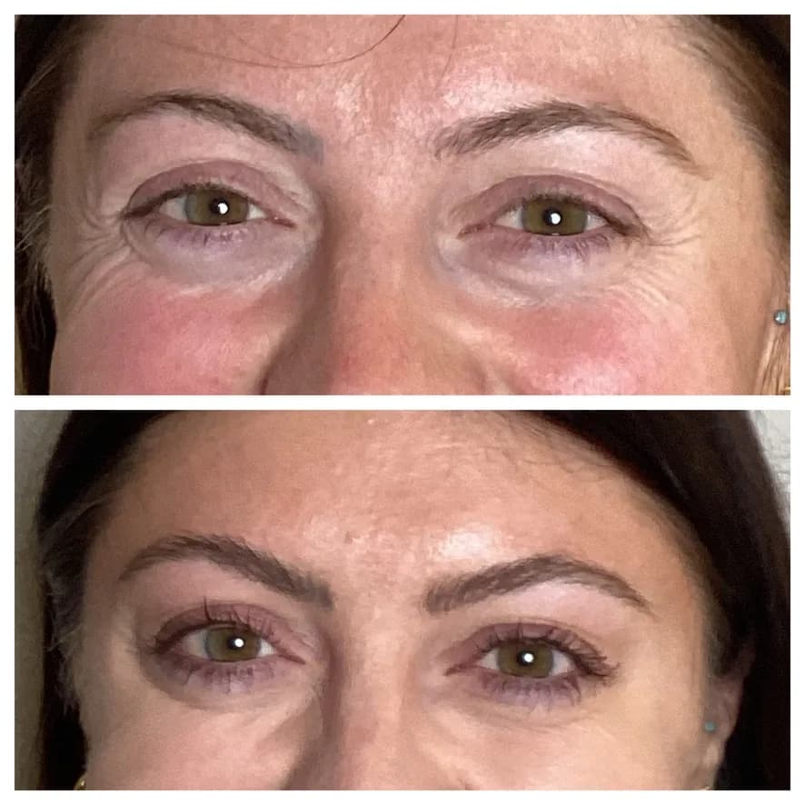 Natural, expressive result after preventative Dysport in Austin
