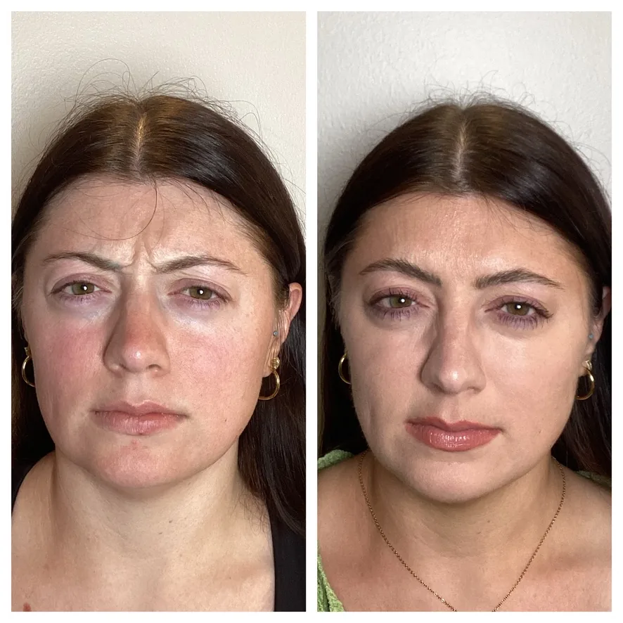Frown lines 11s before and after Botox at Banyan and Bamboo Austin TX