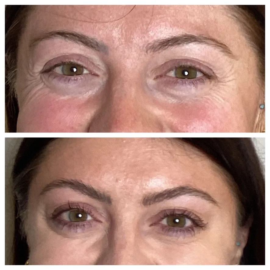 Smiling tox before and after Botox at Banyan and Bamboo Austin TX
