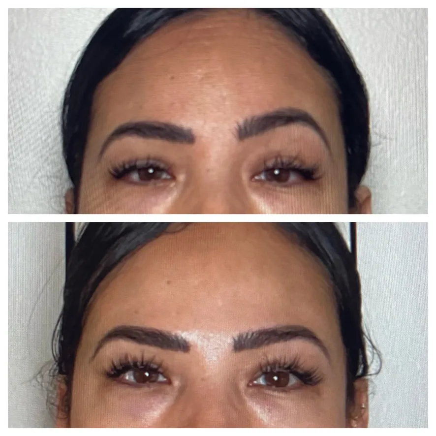 Uneven brow correction with Botox before and after at Banyan and Bamboo Austin TX