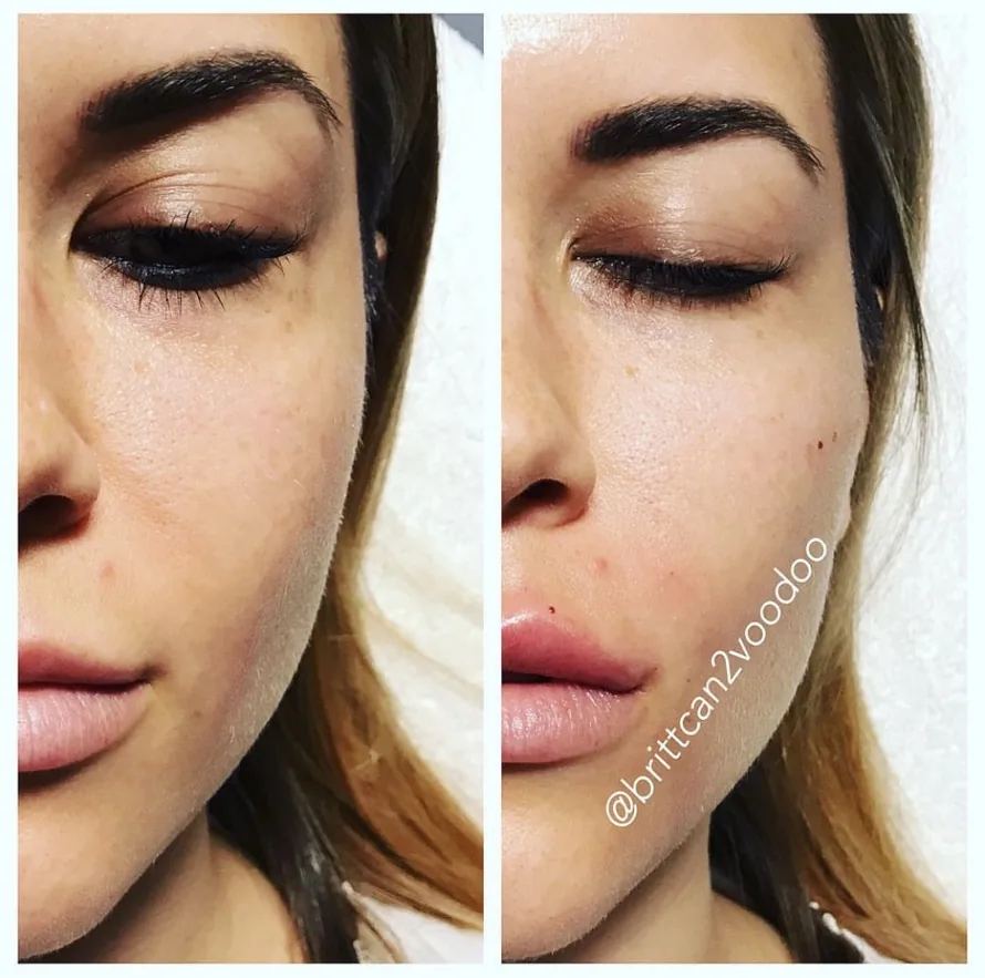 Lip filler and facial balancing before and after at Banyan and Bamboo Austin TX