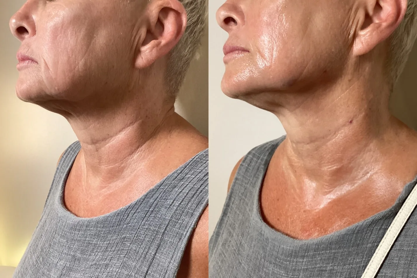 Sculptra jawline and profile before and after at Banyan and Bamboo Austin TX