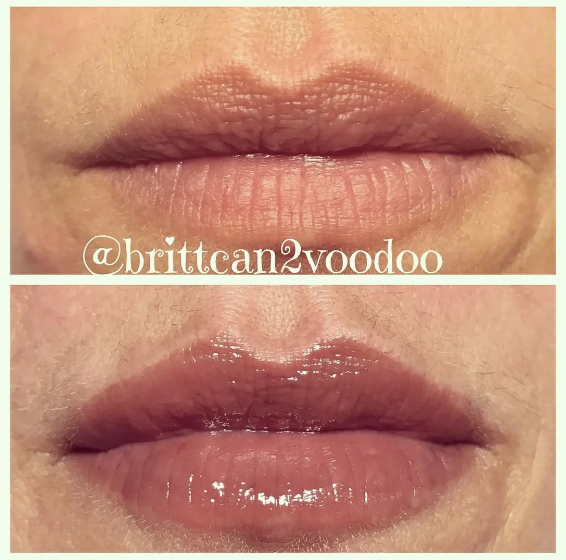 Lip filler volume restoration before and after at Banyan and Bamboo Austin TX