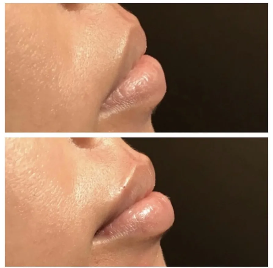 Lip filler side profile before and after at Banyan and Bamboo Austin TX med spa