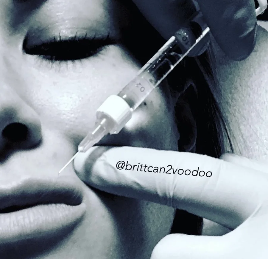 Cheek filler injection by Brittany Cantu at Banyan and Bamboo Austin TX med spa