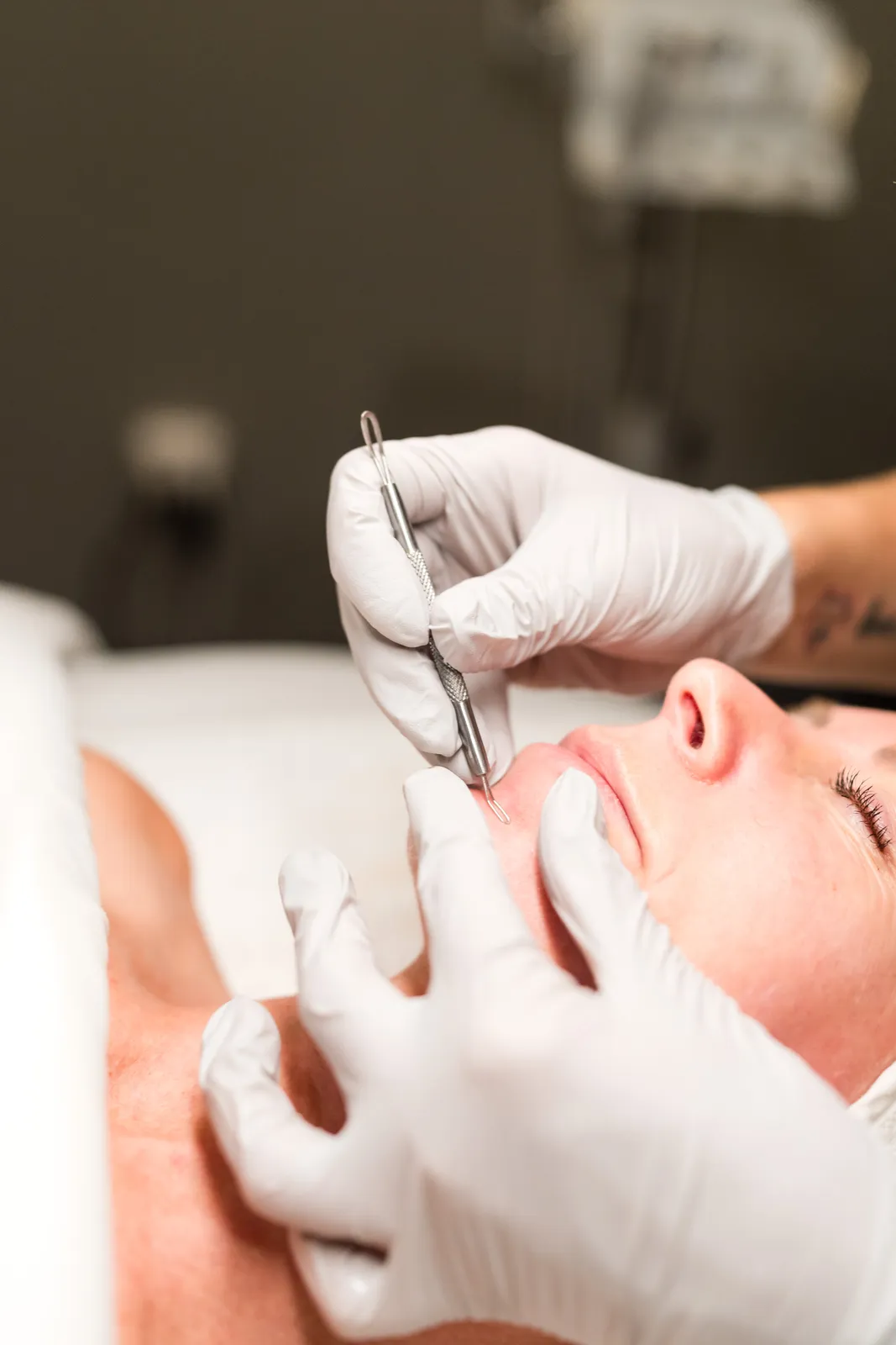 Laser Skin Resurfacing