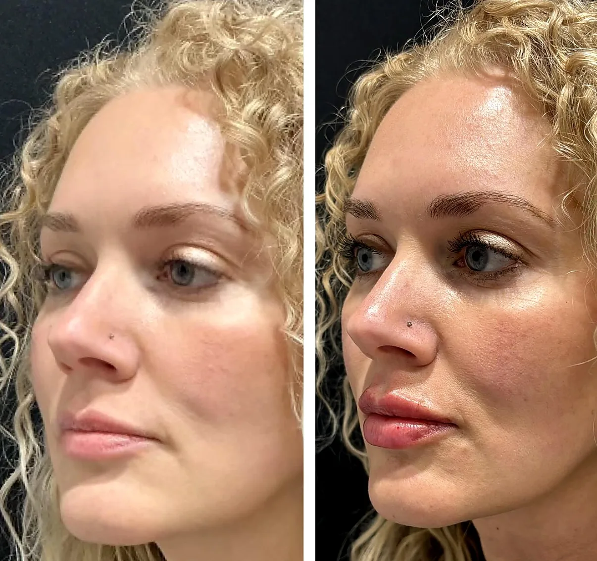 Facial balancing before and after — Facial Balancing — Filler — Banyan & Bamboo Austin