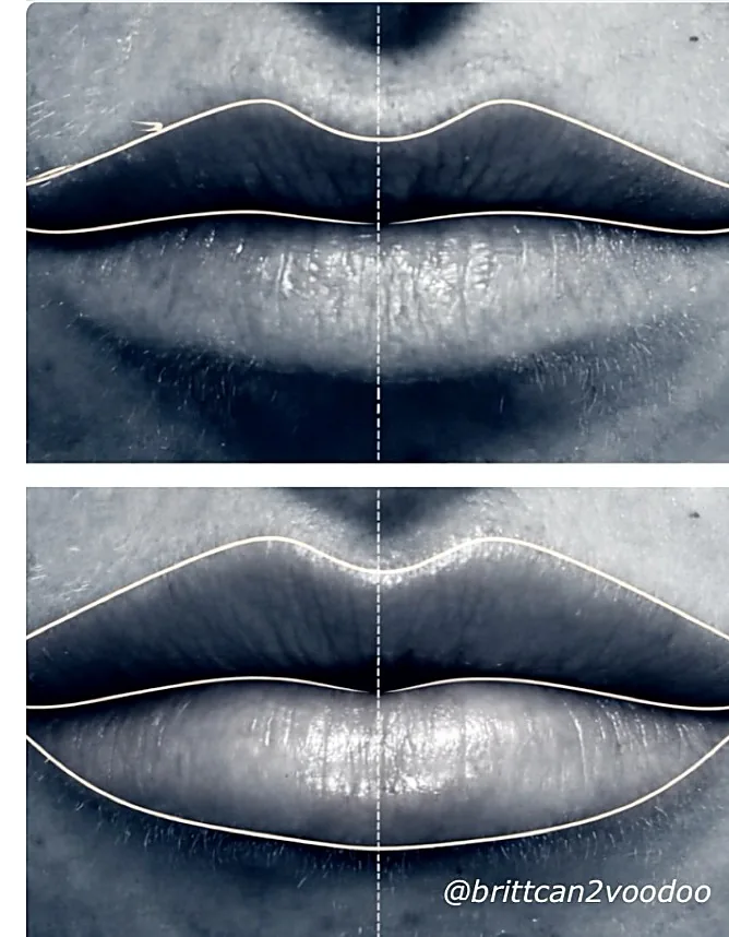 Facial balancing before and after — Lip Enhancement — Filler — Banyan & Bamboo Austin