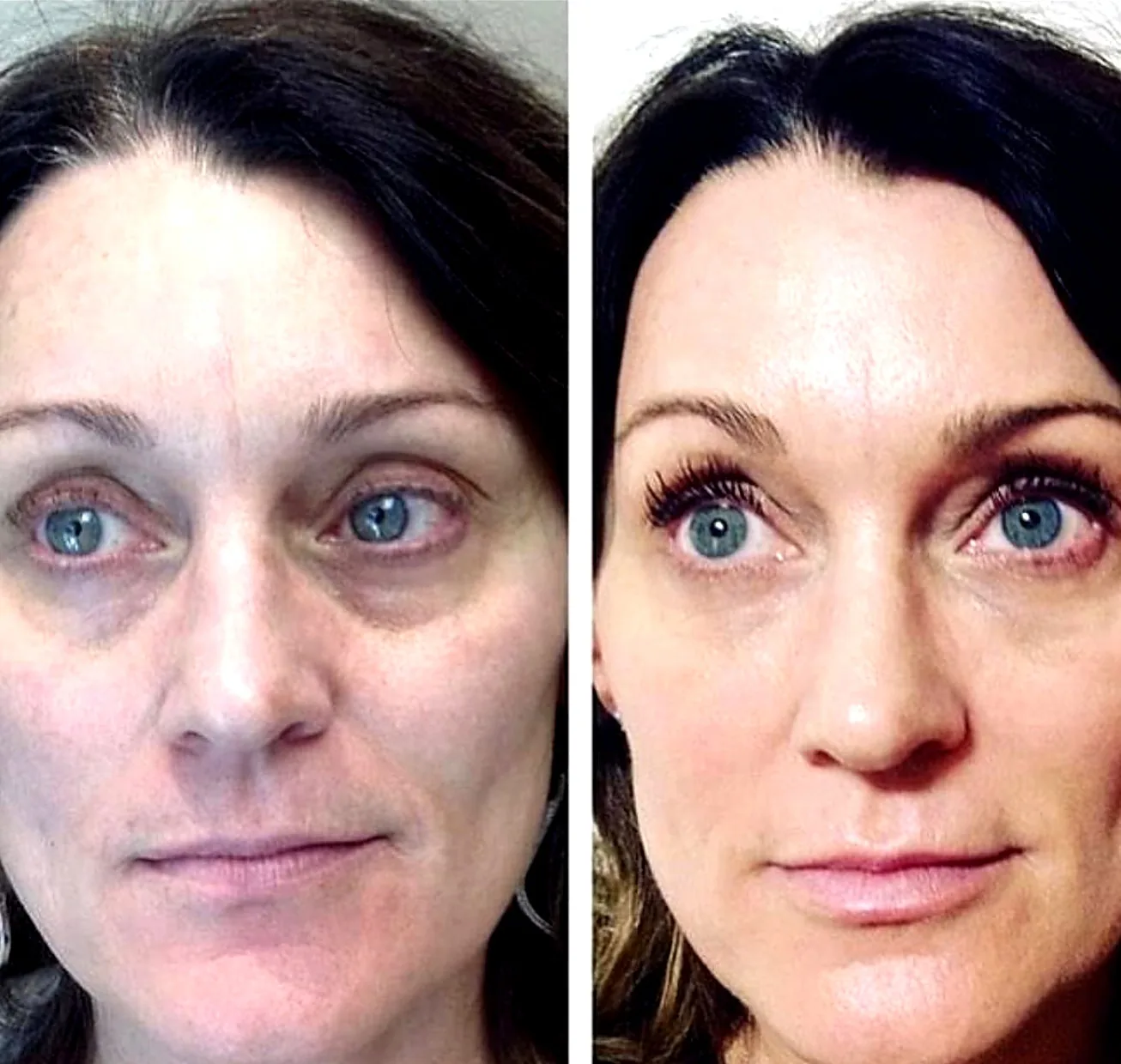 Facial balancing before and after — Full Face — Sculptra + Filler + Tox — Banyan & Bamboo Austin