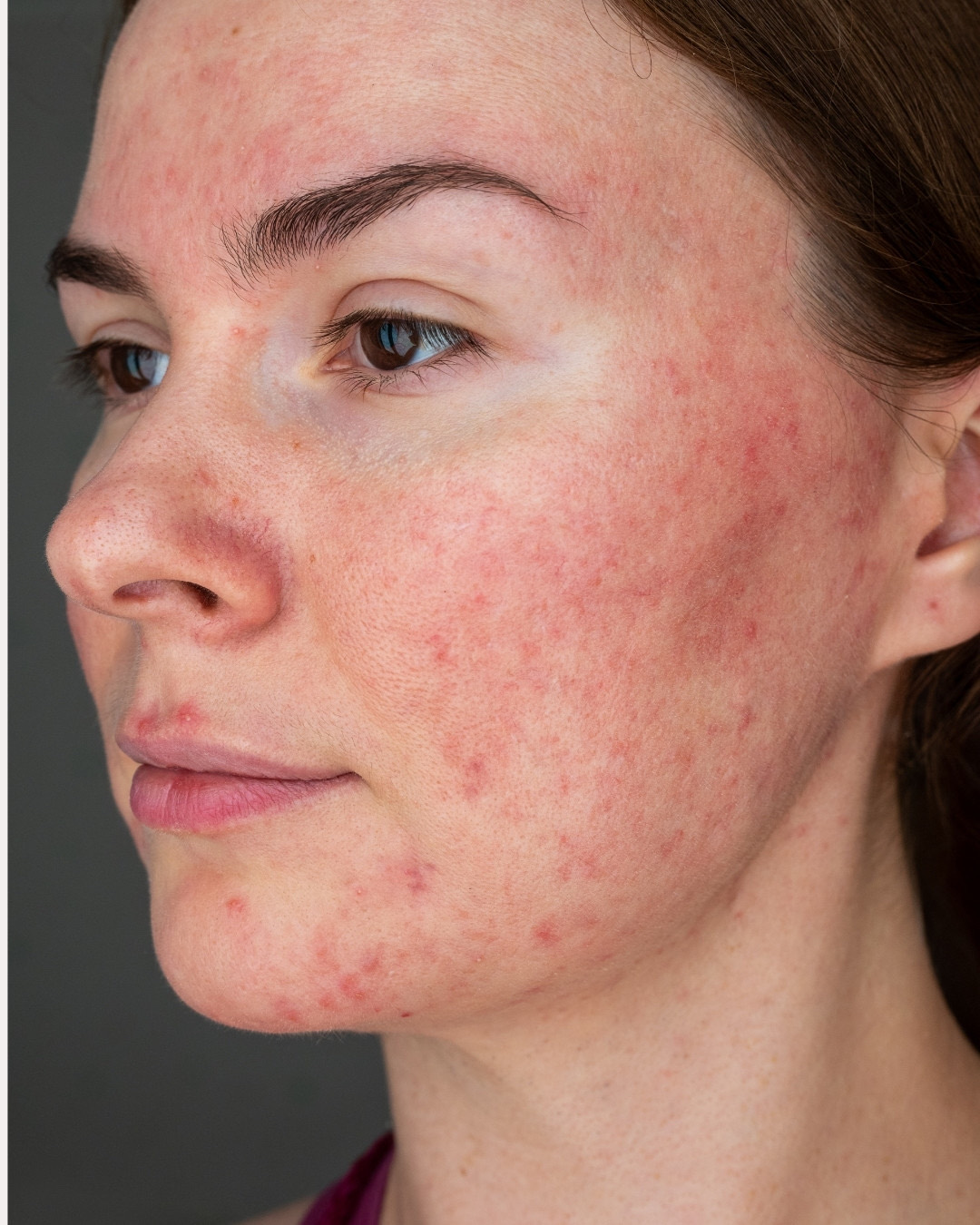 Sun damage