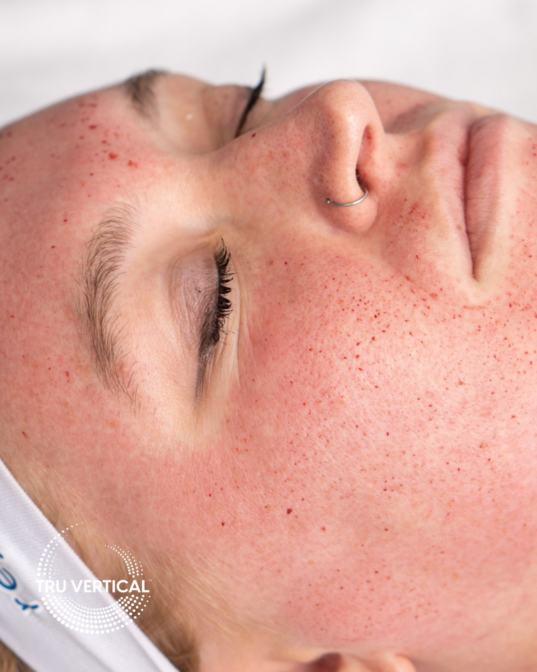 Microneedling