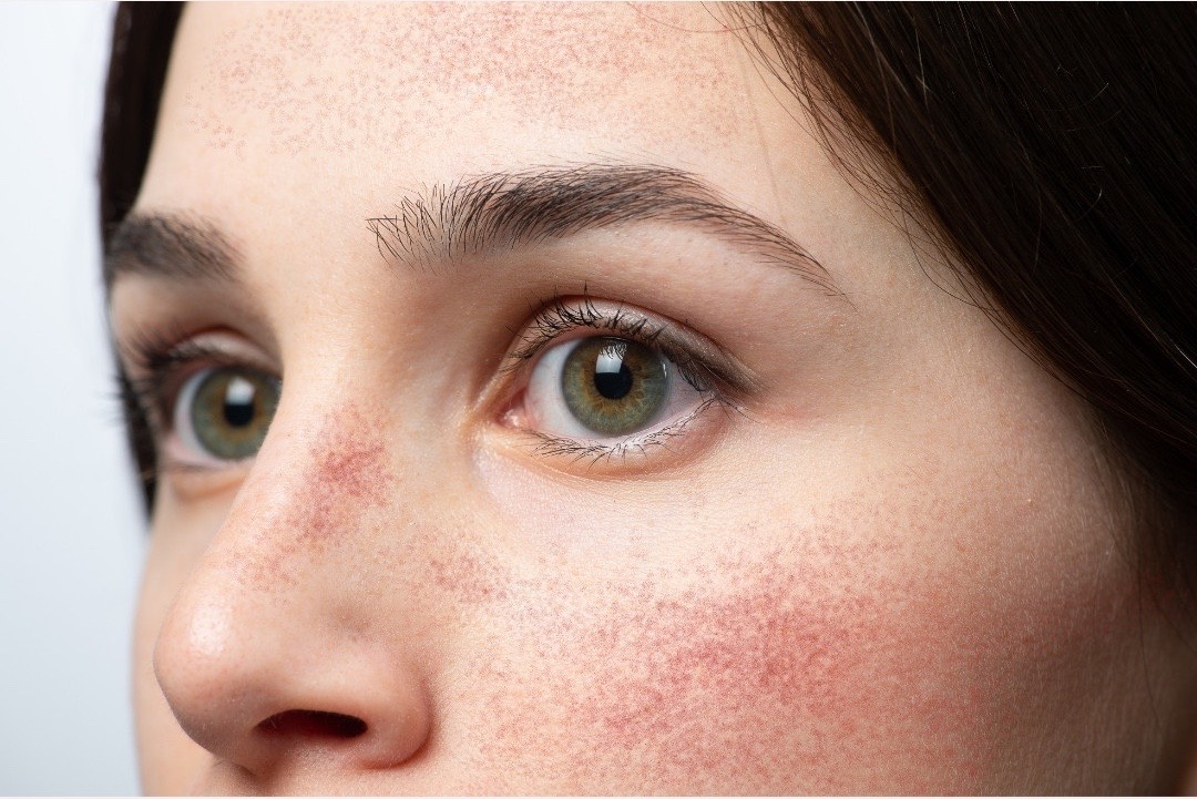 Spider Vein and Vascular Laser Treatment in Austin, TX at Banyan and Bamboo, South Lamar Austin TX