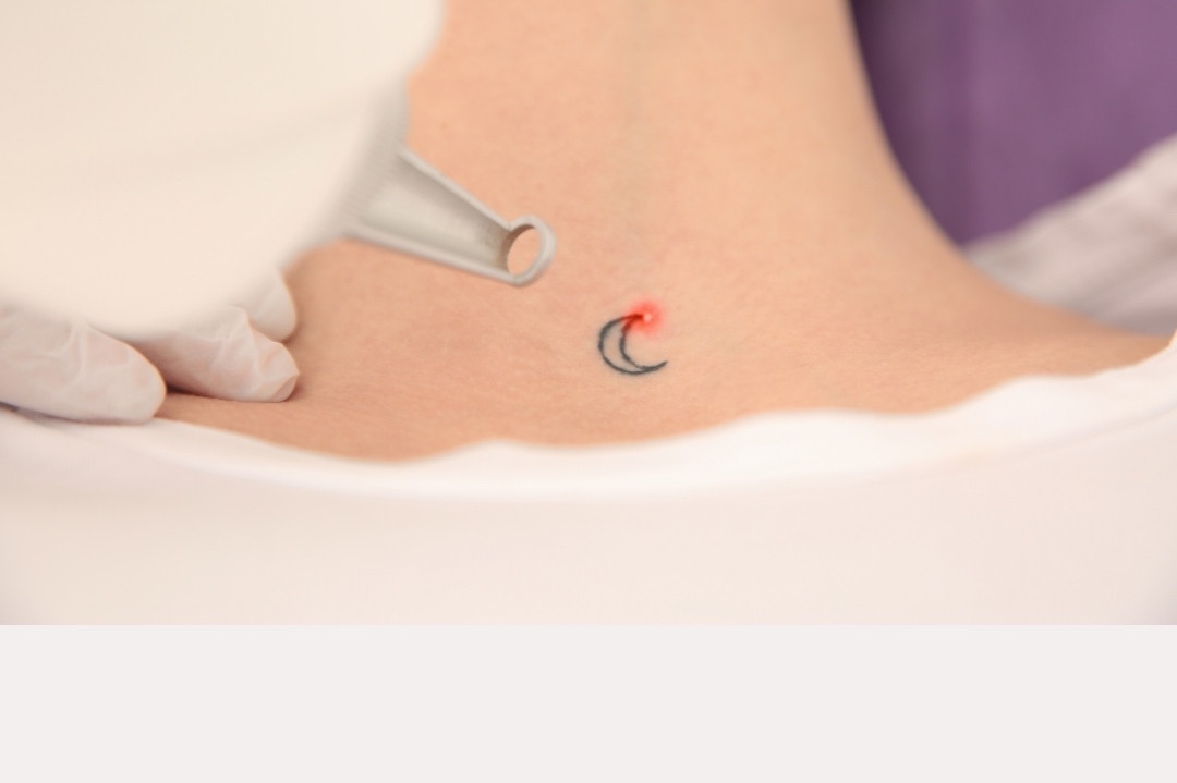 Laser Tattoo Removal in Austin, TX at Banyan and Bamboo, South Lamar Austin TX