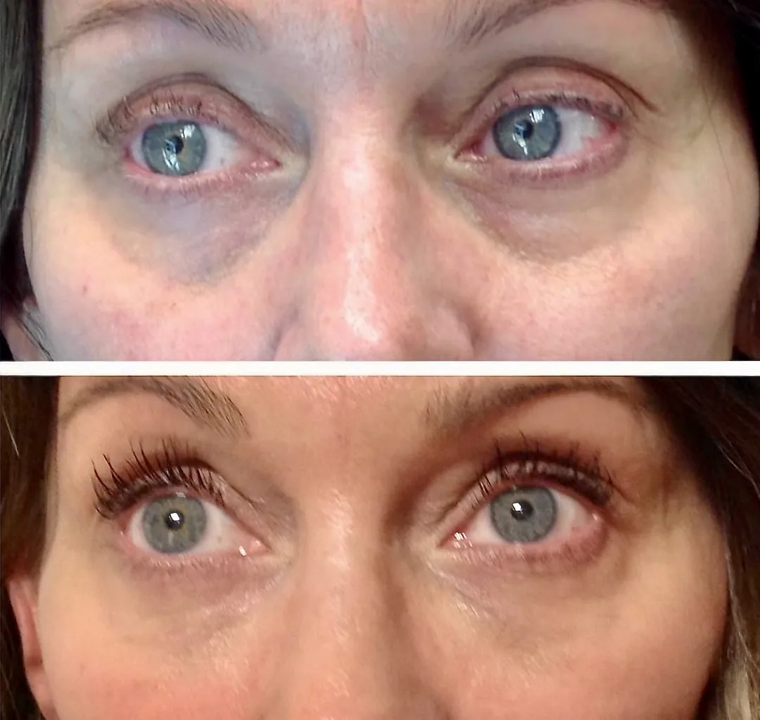 Light Eyes Ultra before and after dark circles treatment at Banyan and Bamboo Austin TX