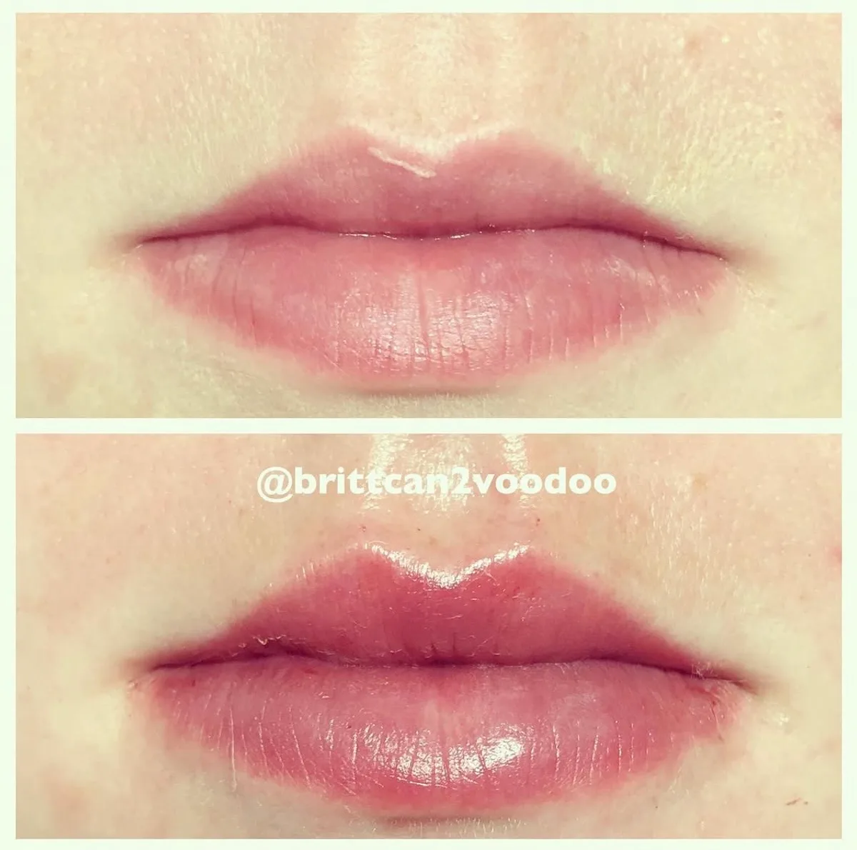 Lip filler before and after, hydration and definition, Banyan and Bamboo Austin