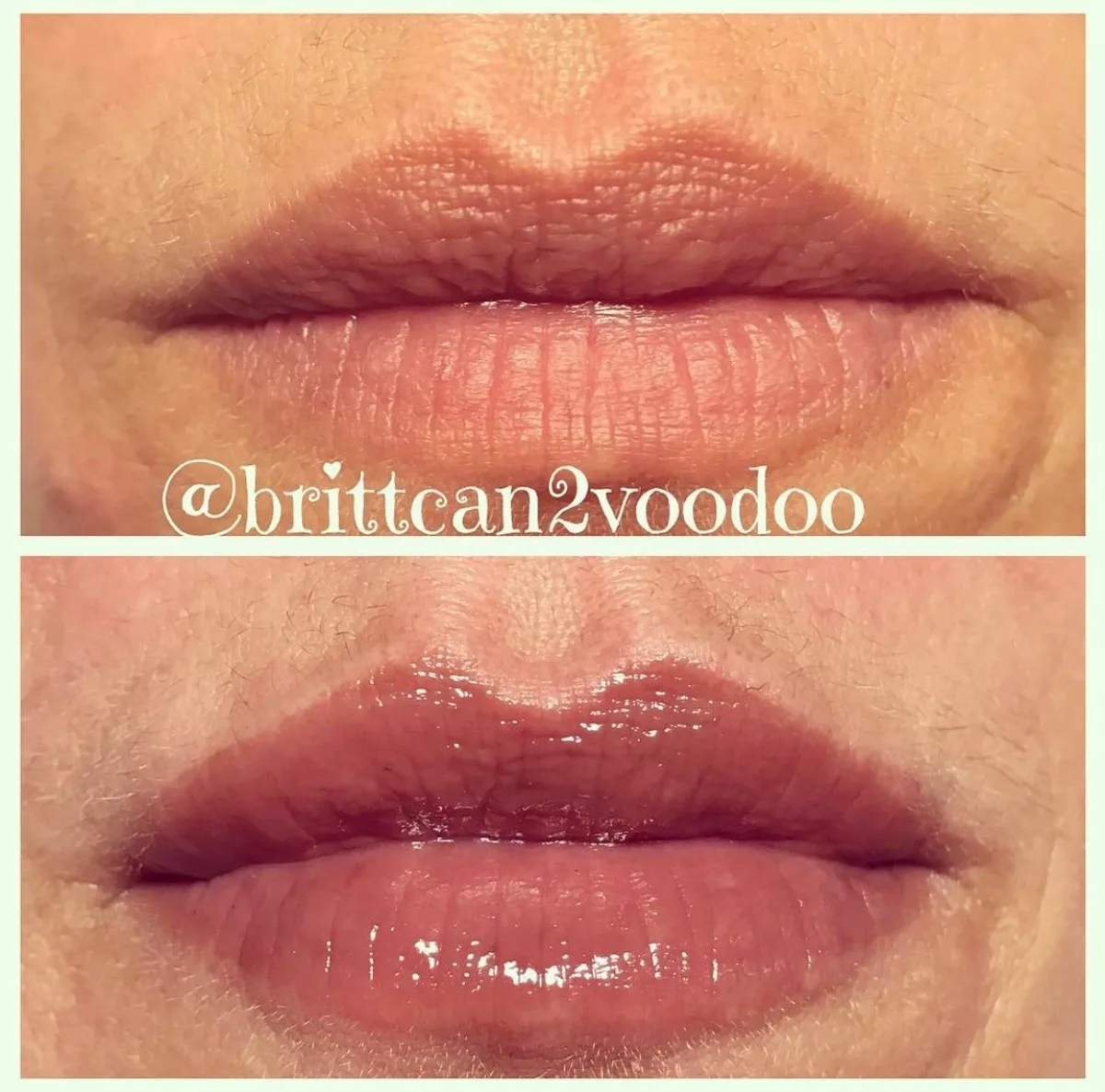 Lip filler before and after smoothing vertical lip lines, Banyan and Bamboo Austin