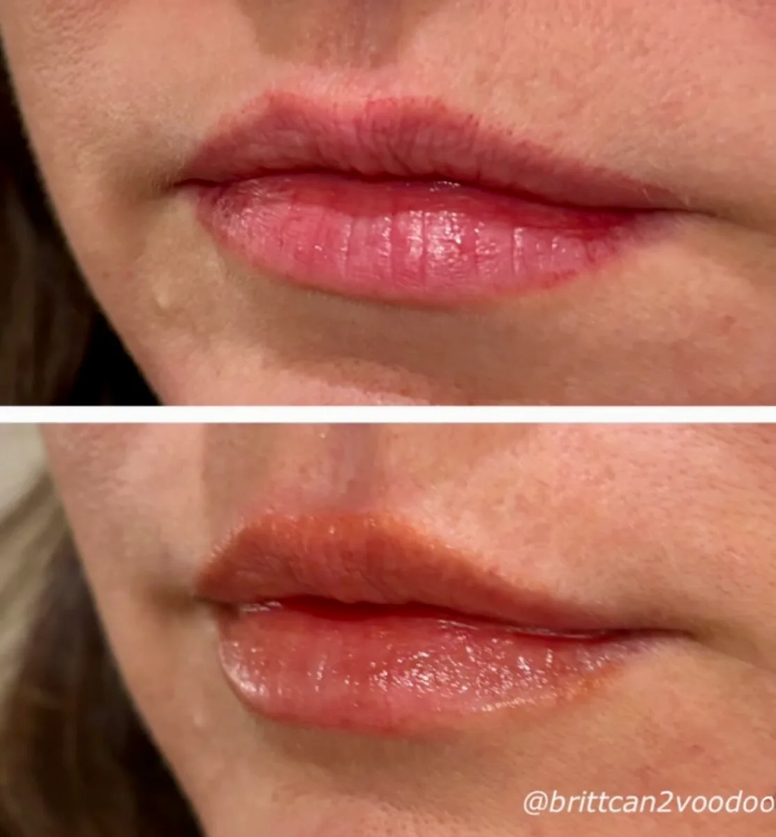 Lip filler before and after, balanced top and bottom lip, Banyan and Bamboo Austin