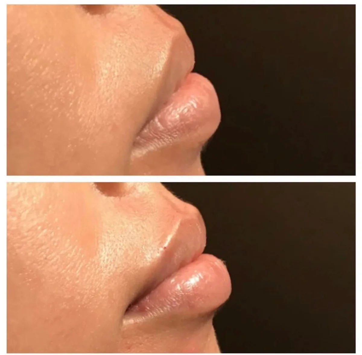 Lip filler before and after in profile showing natural projection, Banyan and Bamboo Austin