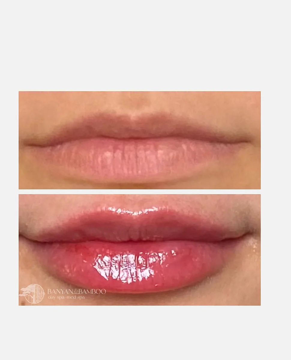 Lip filler before and after by Brittany Cantu at Banyan and Bamboo in Austin, TX