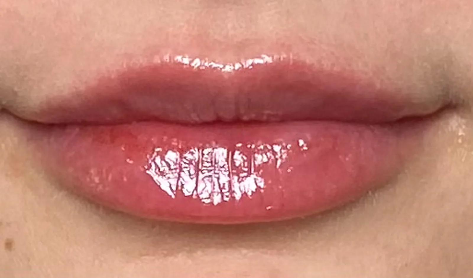 Lip filler being placed by Brittany Cantu, AME at Banyan and Bamboo in South Austin, TX