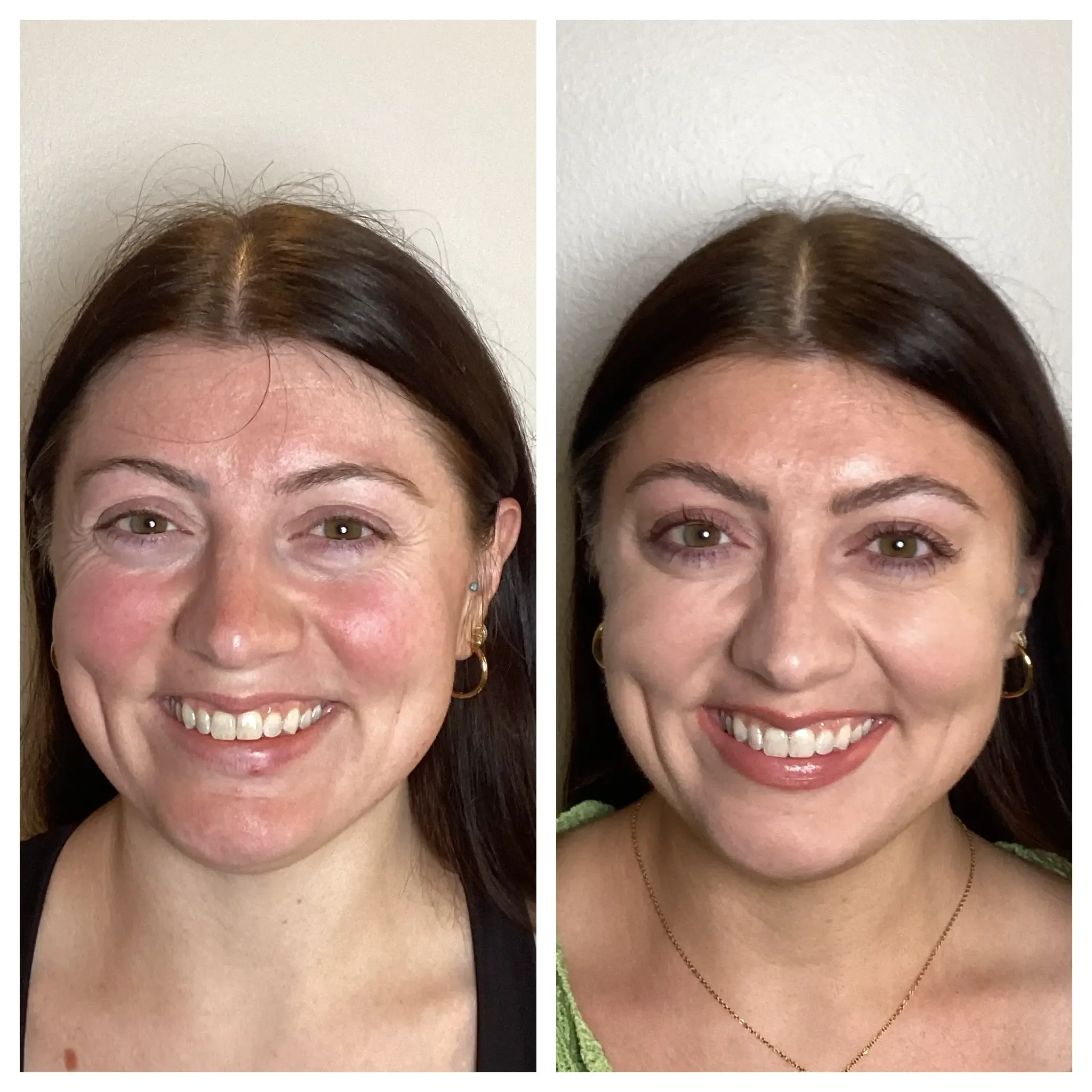 Dysport before and after front view real patient at Banyan and Bamboo Austin TX med spa
