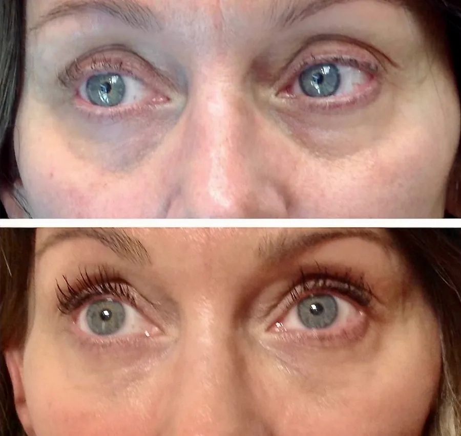 Light Eyes Ultra PDRN under-eye before and after dark circles treatment at Banyan and Bamboo Austin TX