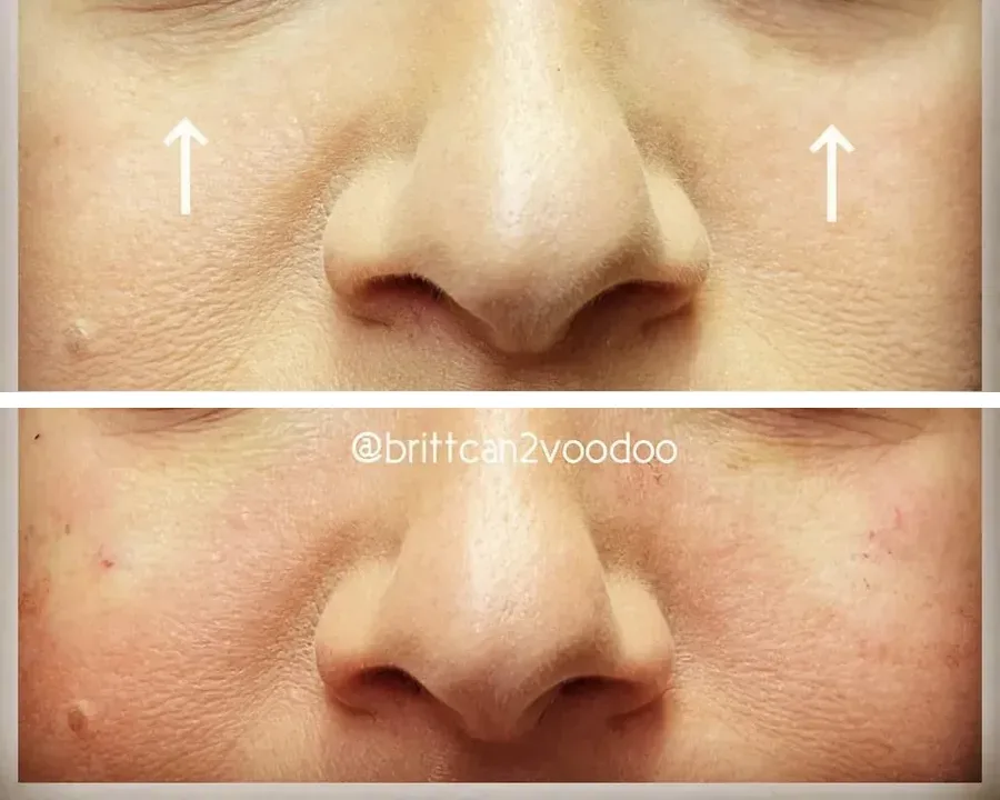 Light Eyes Ultra PDRN mesotherapy before and after under-eye restoration Brittany Cantu Banyan and Bamboo Austin TX