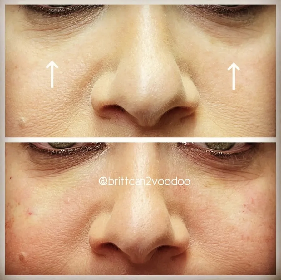 Light Eyes Ultra injectable mesotherapy before and after dark circles Brittany Cantu Banyan and Bamboo Austin TX