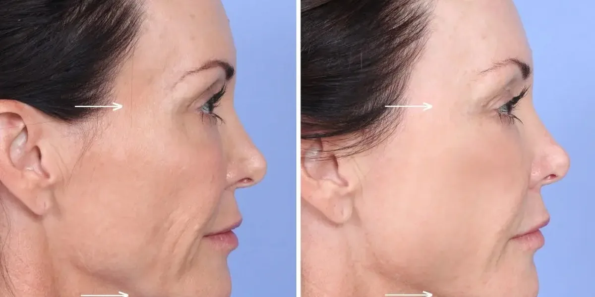 Sculptra collagen biostimulator before and after side profile at Banyan and Bamboo Austin TX