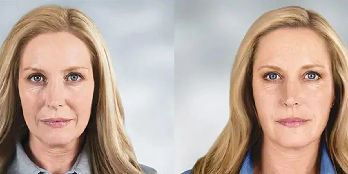 Sculptra full face frontal before and after at Banyan and Bamboo Austin TX