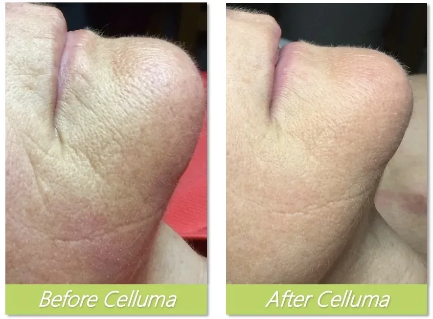 Celluma LED therapy before and after — skin texture improvement