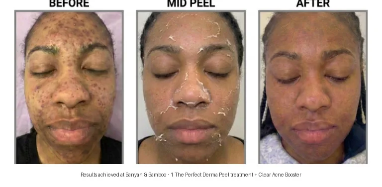 Perfect Derma Peel before and after — 4 treatments for acne scarring and hyperpigmentation