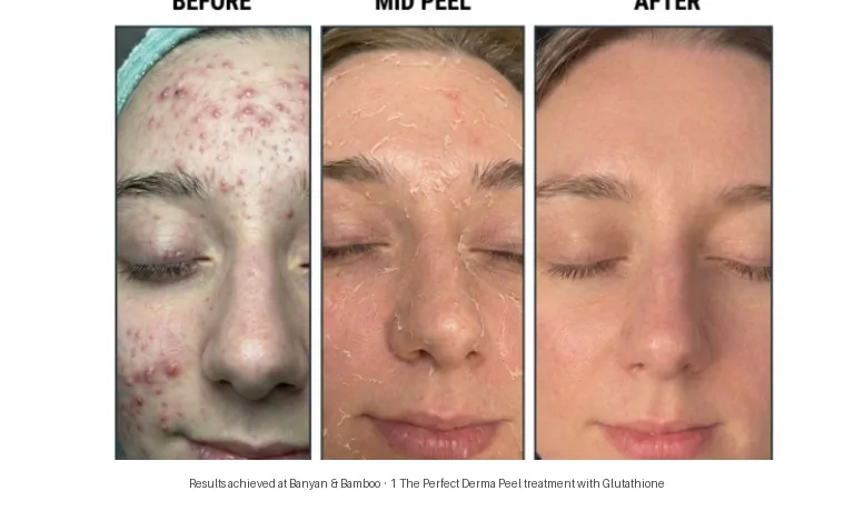 Perfect Derma Peel with Clear Acne Booster before and after — acne and uneven skin tone