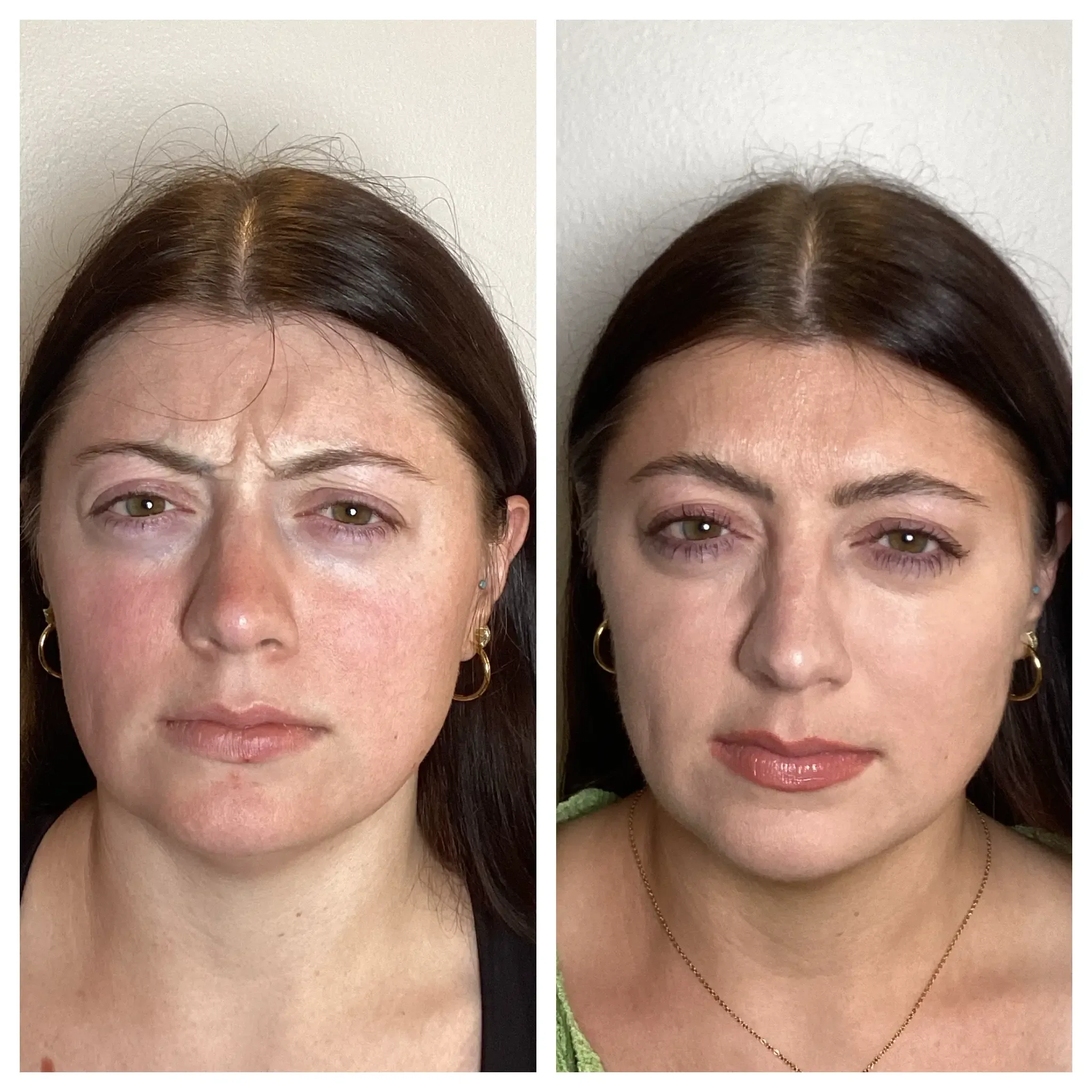 Dysport before and after angle view real patient at Banyan and Bamboo Austin TX med spa