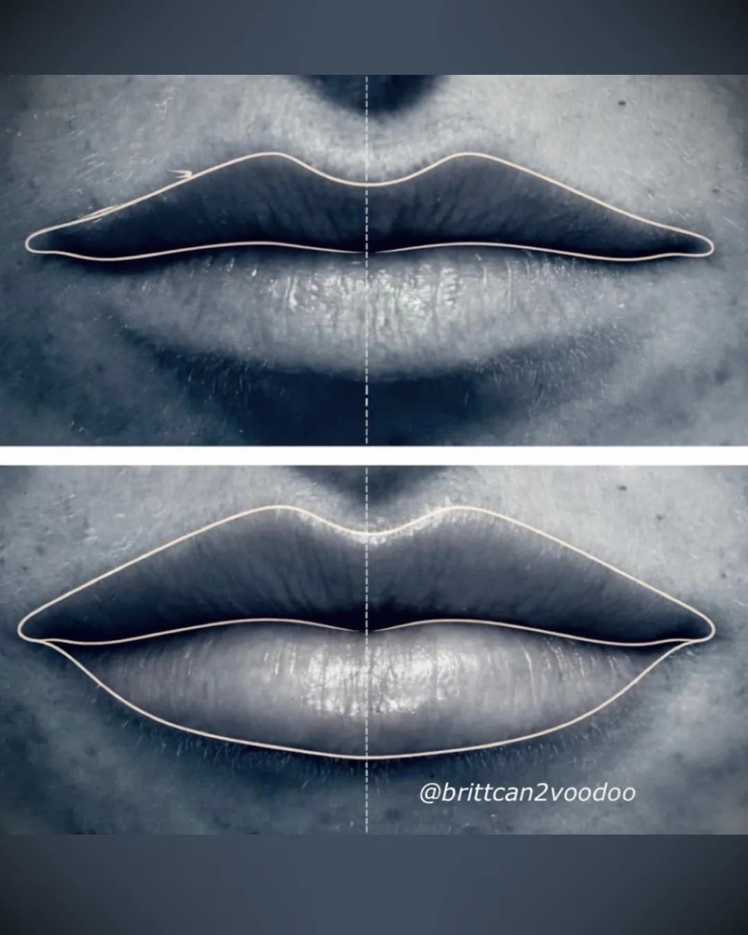 Lip filler before and after natural results at Banyan and Bamboo Austin TX med spa