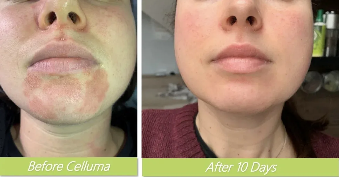 Celluma LED therapy before and after — facial redness and skin healing