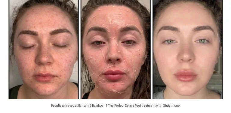 Perfect Derma Peel before and after — darker skin tone, safe for all Fitzpatrick types