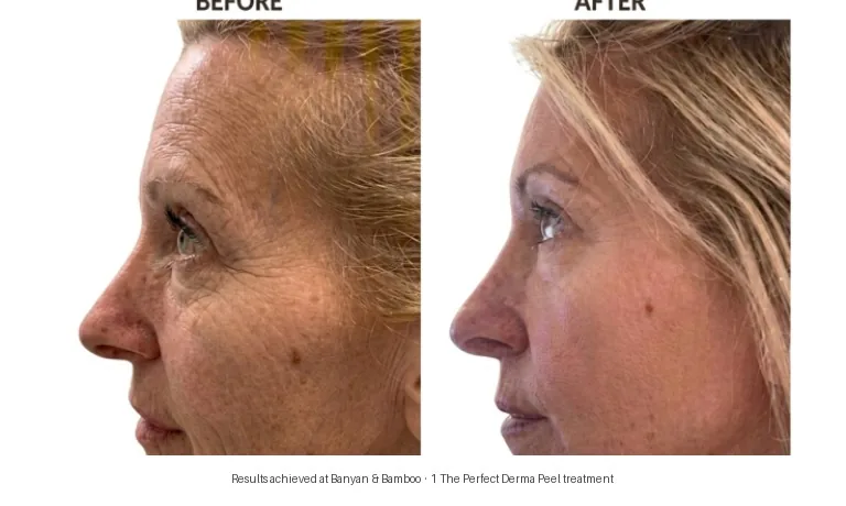 Perfect Derma Peel before and after — sun damage and skin texture improvement, side profile