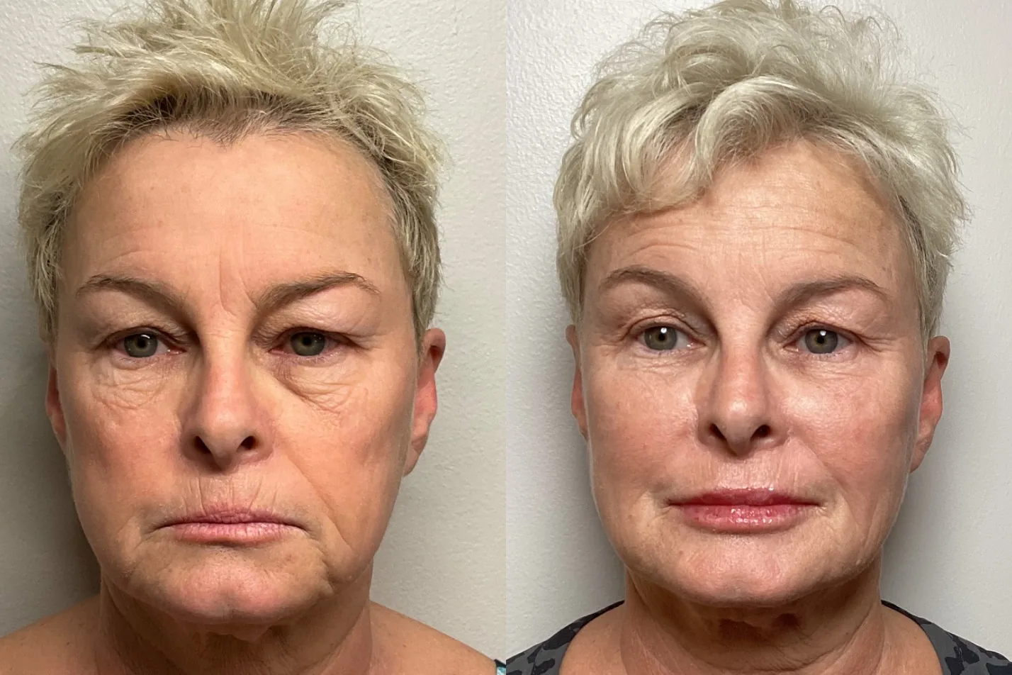 Ozempic Face volume loss and restoration — Banyan & Bamboo Med Spa Austin