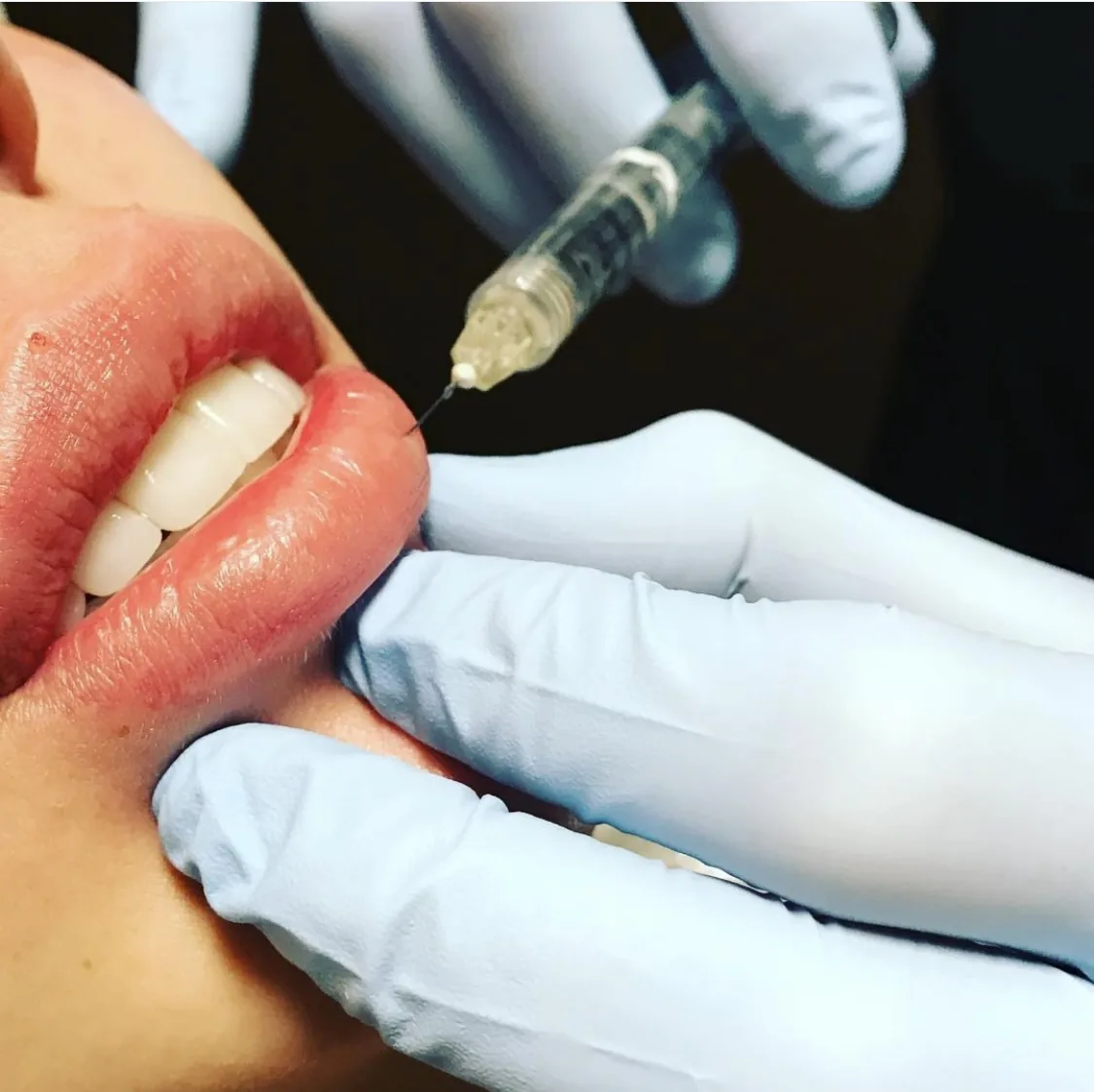 Lip filler and lip flip injectable special at Banyan and Bamboo Med Spa South Lamar Austin TX
